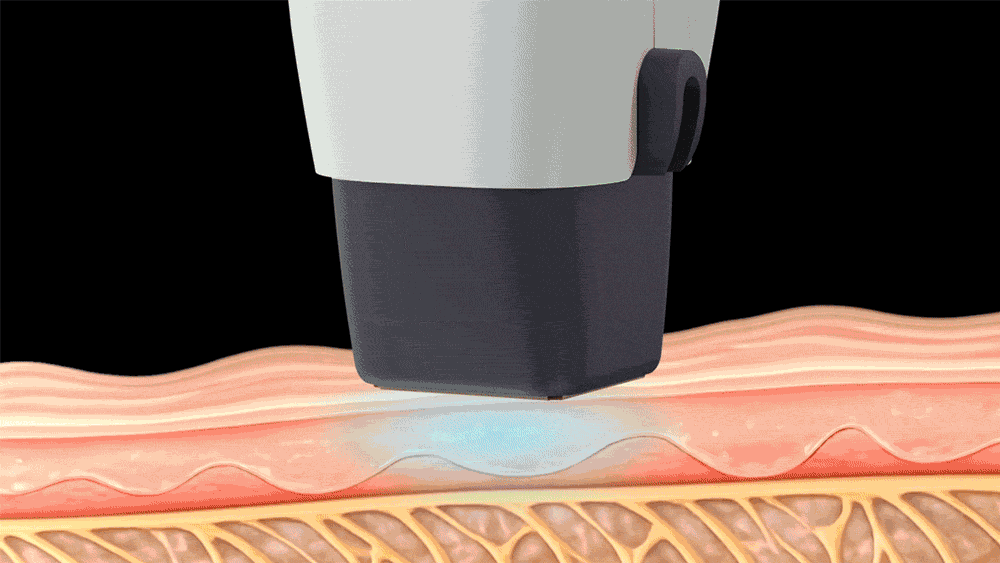 單極電波原理示意圖